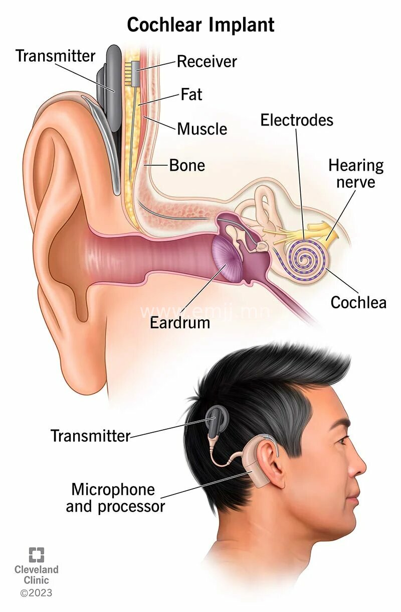 emjj/product/2024/01/11/7uuko371cjb7o88s/4806-cochlear-implant